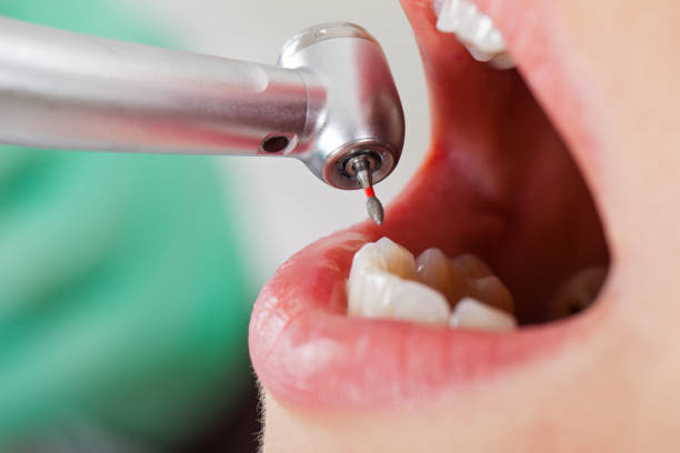 Best Broken or Cracked Tooth Emergency Dentist in Fruitvale, CO